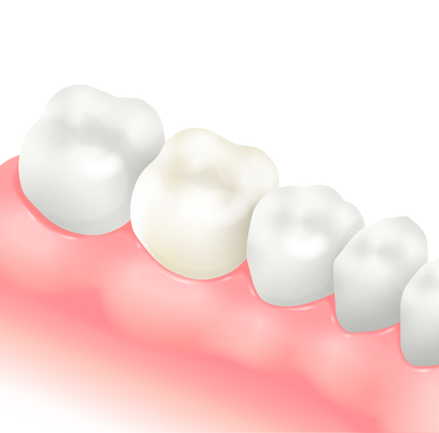 セラミックインレーセラミッククラウン