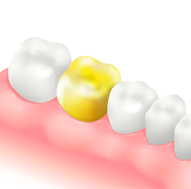 ゴールドインレーゴールドクラウン