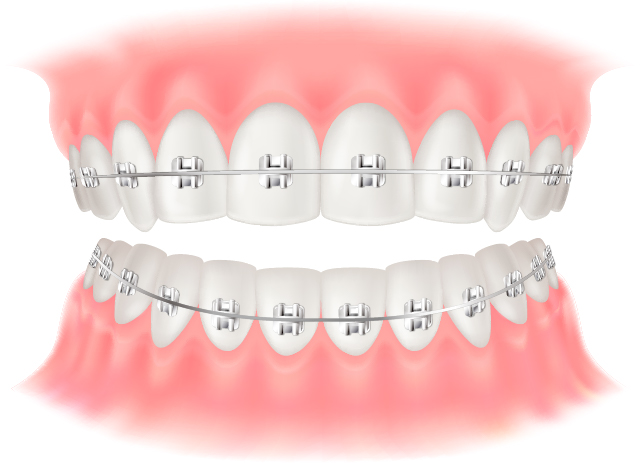 マルチブラケット（金属）